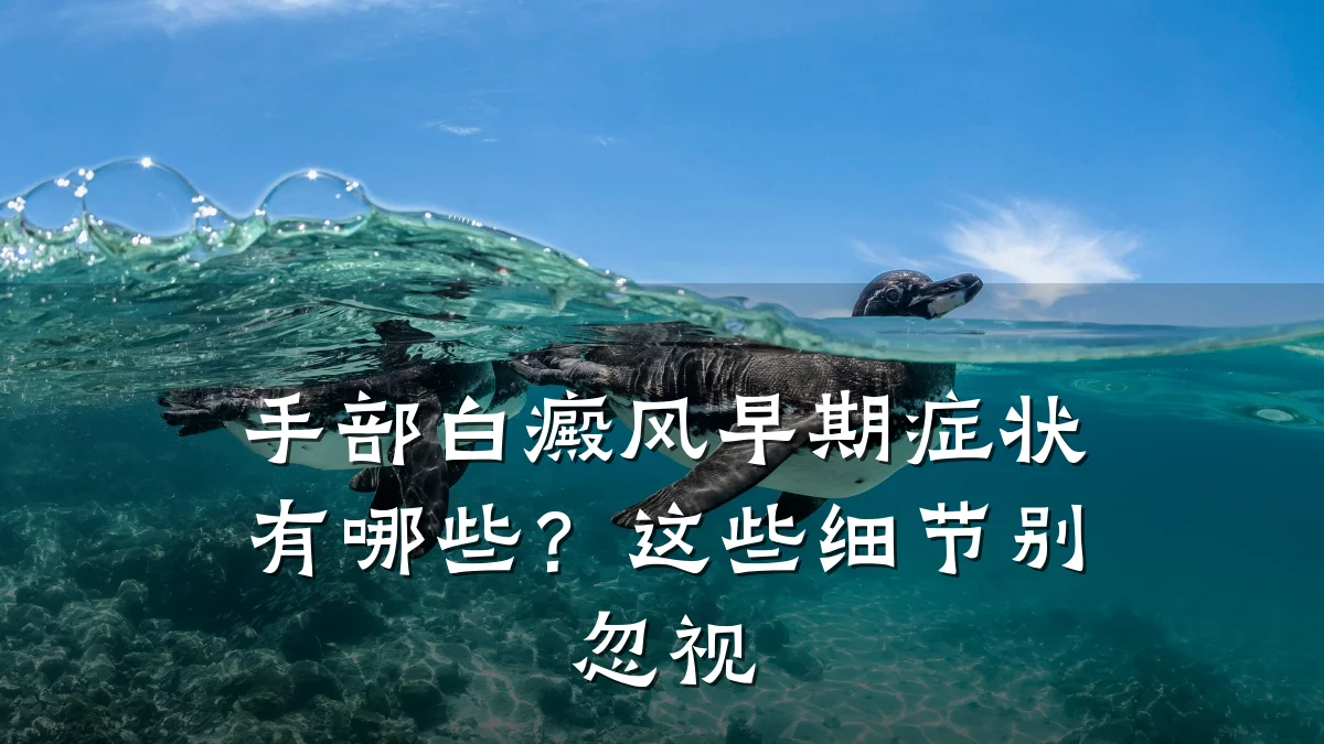 手部白癜风早期症状有哪些?这些细节别忽视