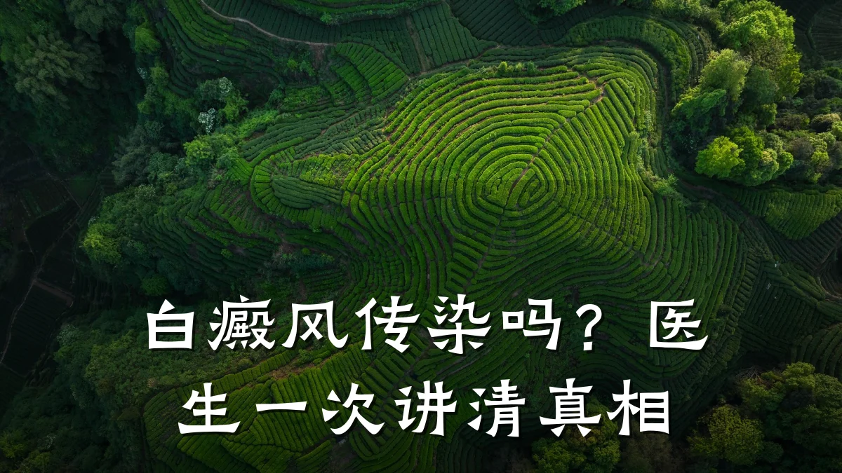 白癜风传染吗?医生一次讲清真相
