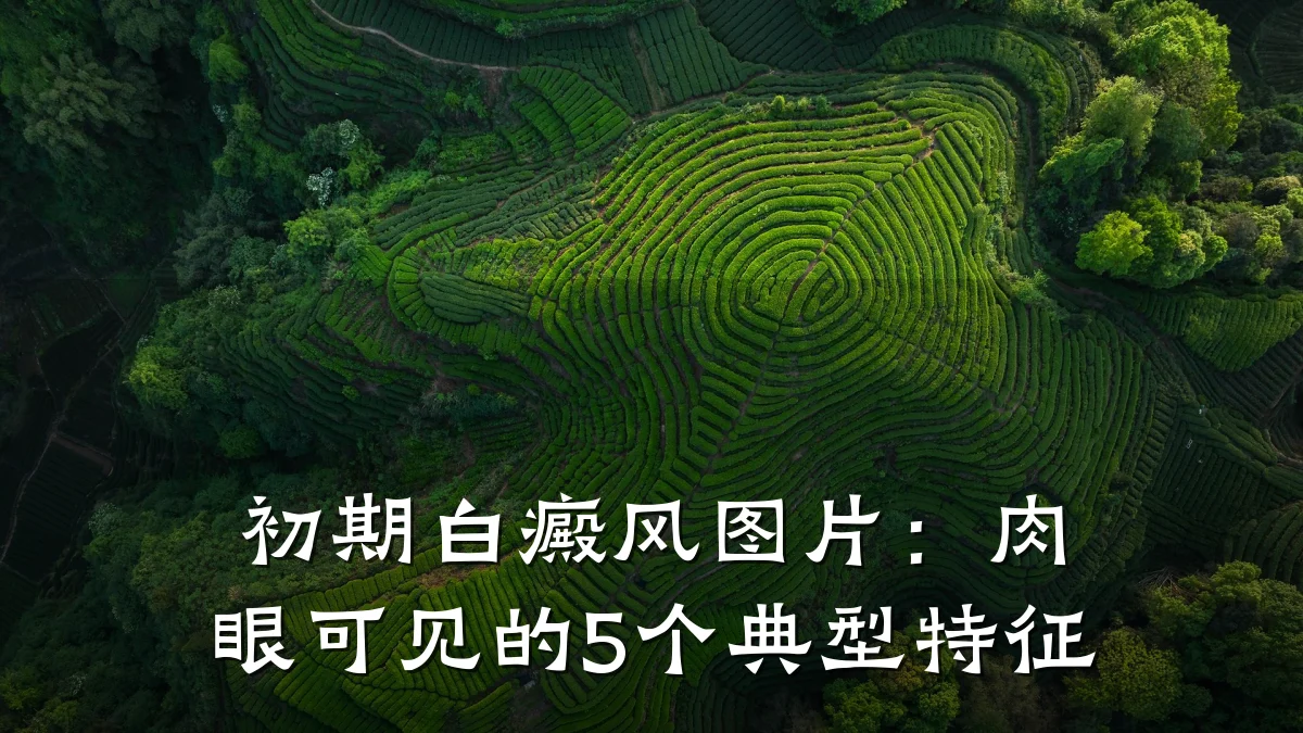 初期白癜风图片:肉眼可见的5个典型特征