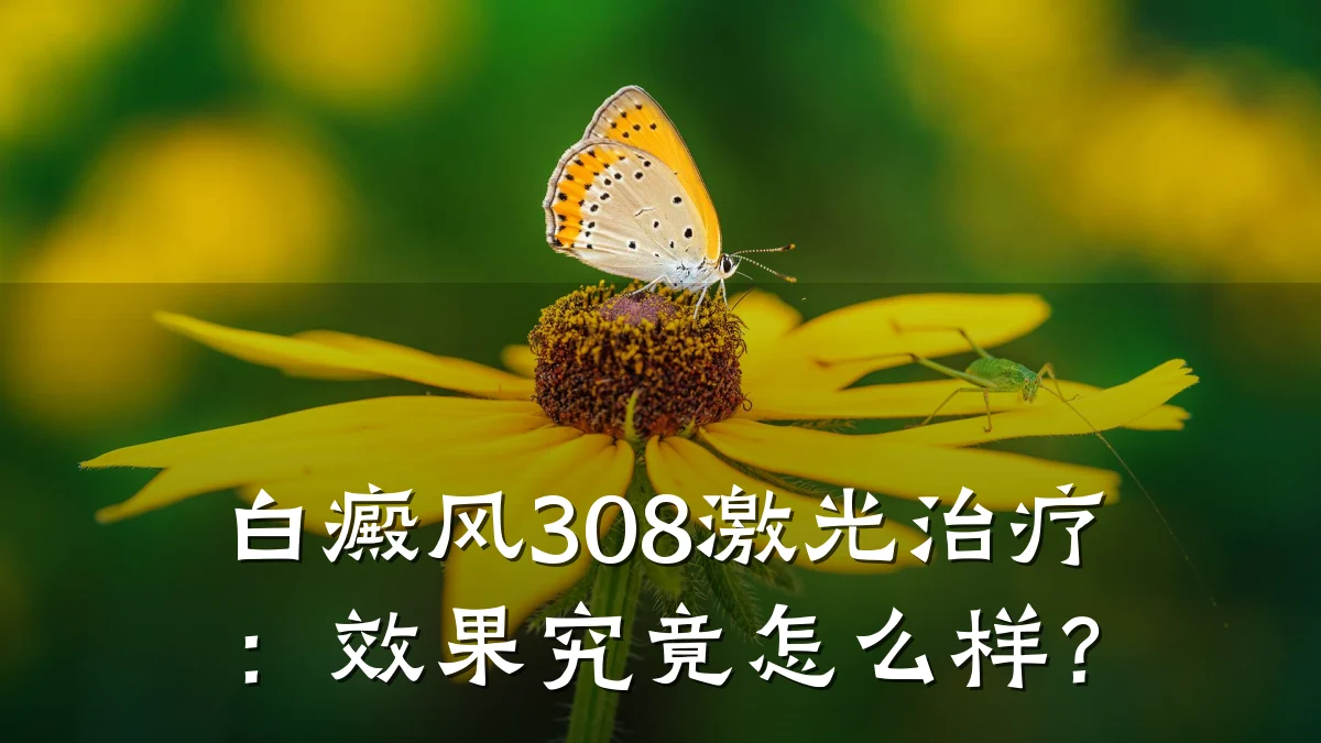 白癜风308激光治疗:效果究竟怎么样?