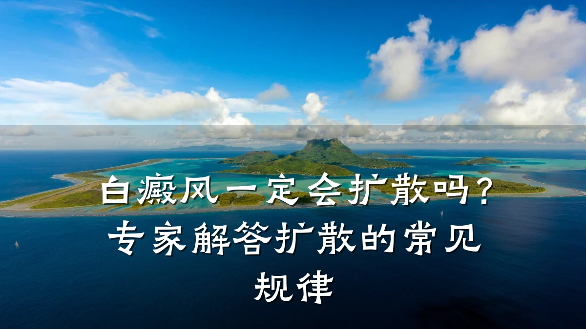 白癜风一定会扩散吗?专家解答扩散的常见规律