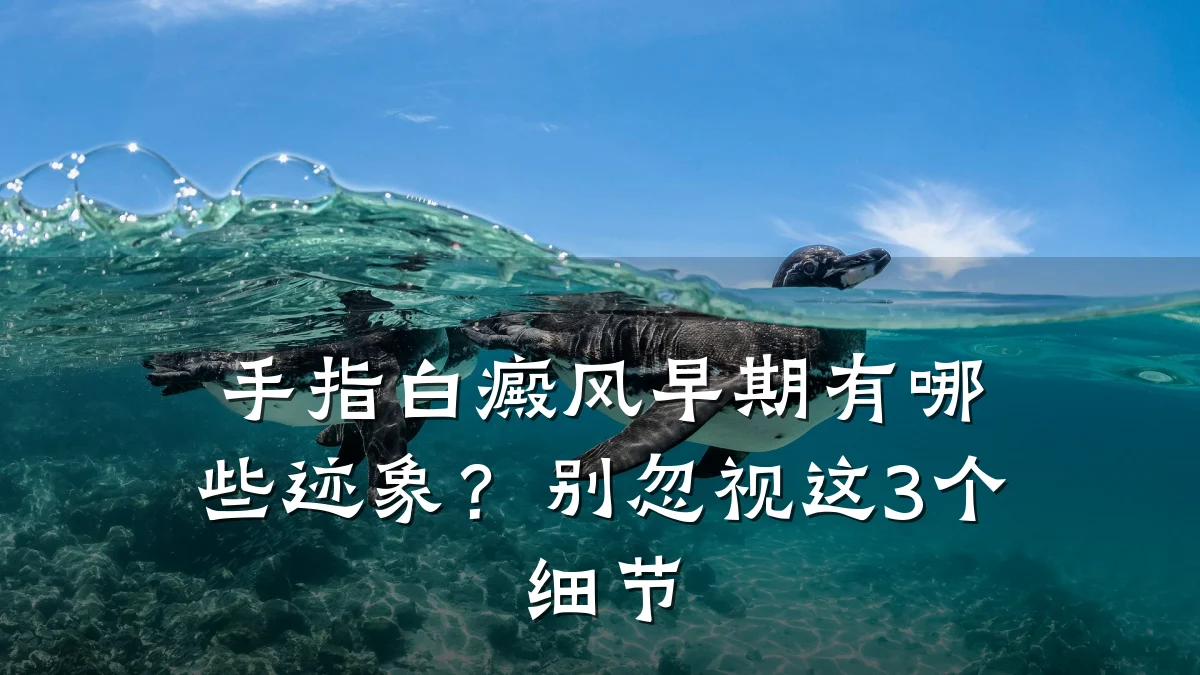 手指白癜风早期有哪些迹象?别忽视这3个细节