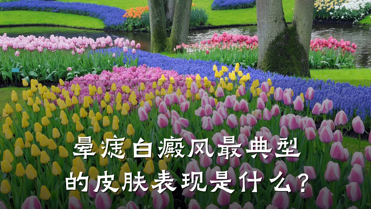 晕痣白癜风最典型的皮肤表现是什么?