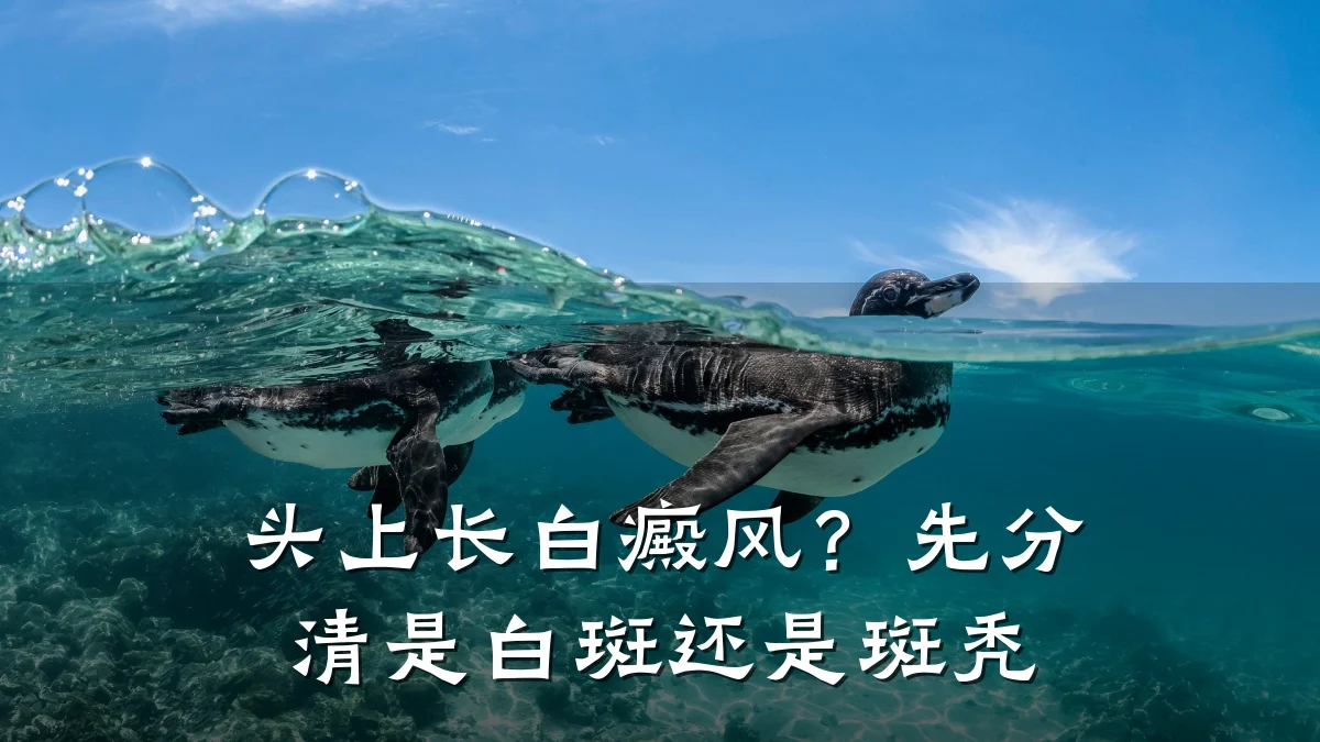 头上长白癜风?先分清是白斑还是斑秃