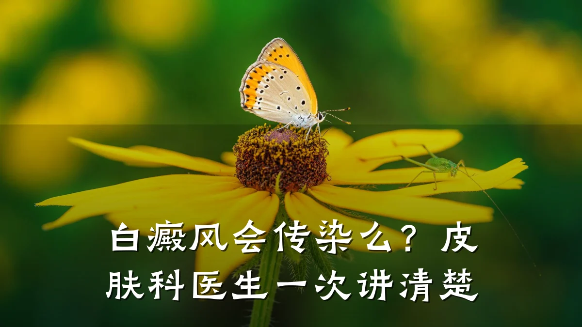 白癜风会传染么?皮肤科医生一次讲清楚