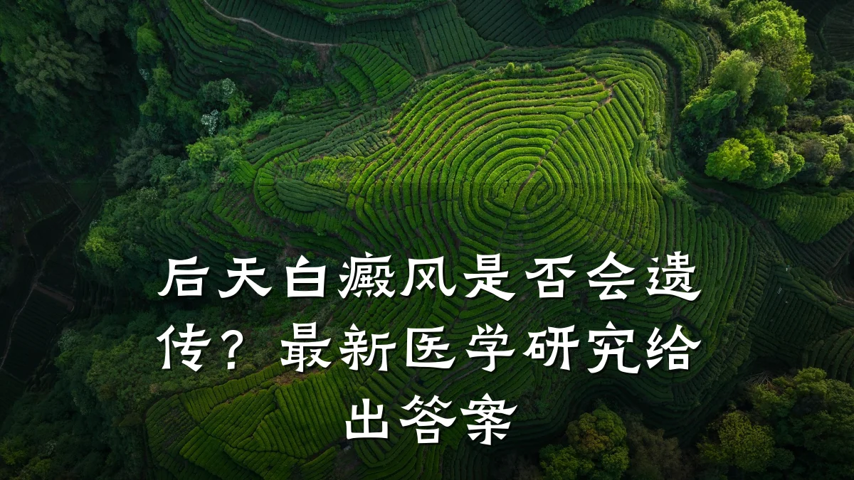 后天白癜风是否会遗传?最新医学研究给出答案