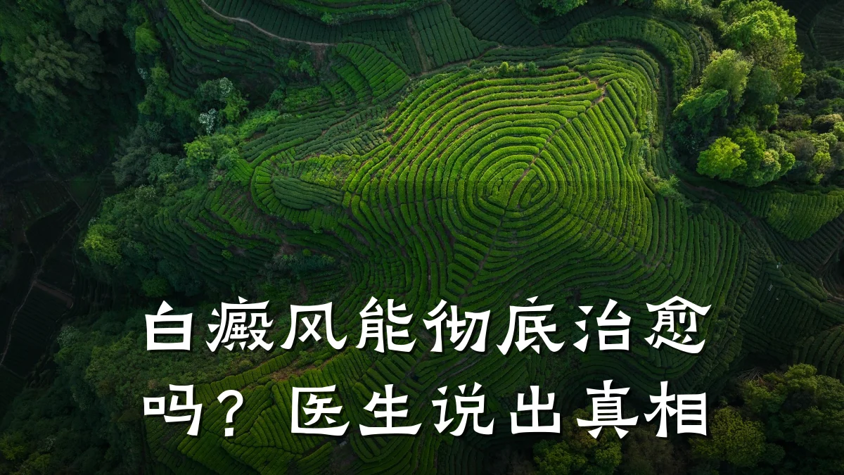 白癜风能彻底治愈吗?医生说出真相
