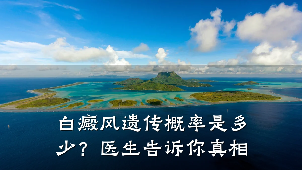 白癜风遗传概率是多少?医生告诉你真相